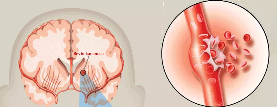 beyin kanamasinin en sik nedeni anevrizma doc dr ali yilmaz