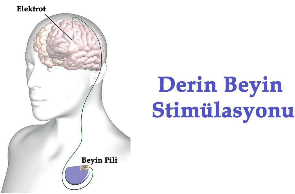 derin beyin stimulasyonu nedir doc dr ali yilmaz